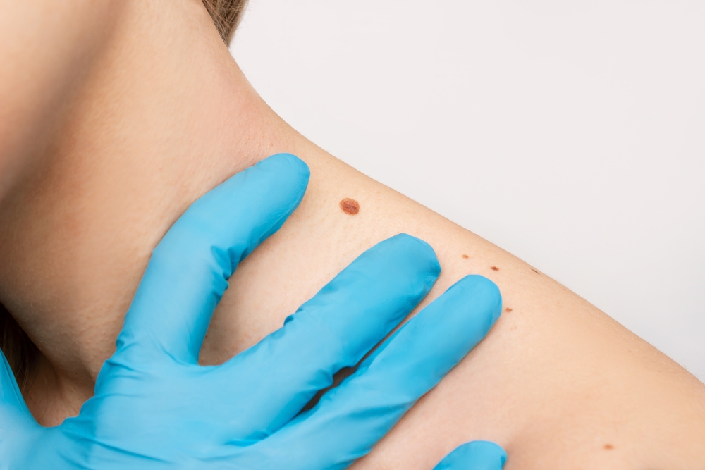 Melanoma Detection