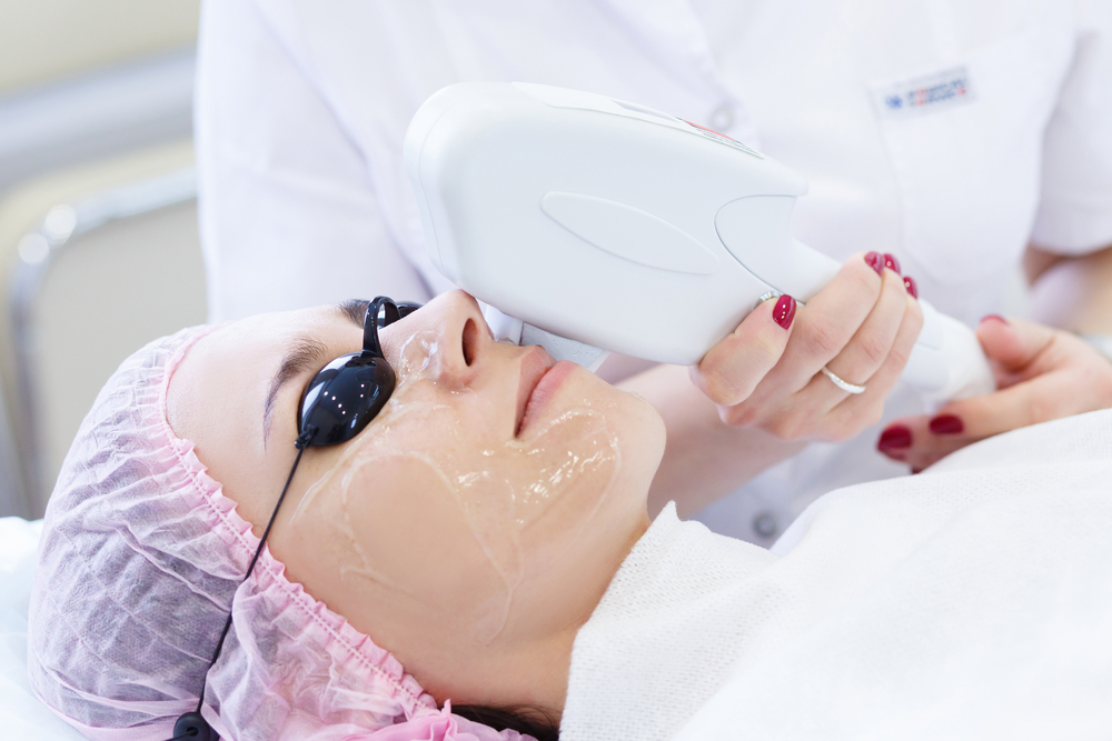 IPL Photofacial